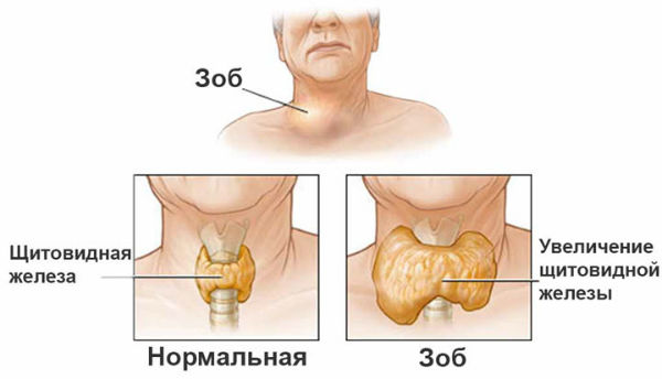 Деформация щитовидки фото