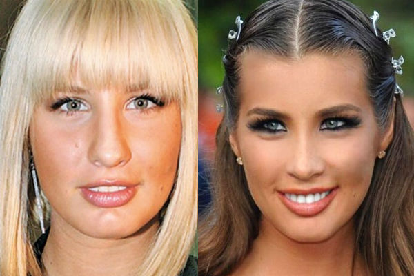 Как изменилась внешность Кети Топурии после ринопластики носа фото