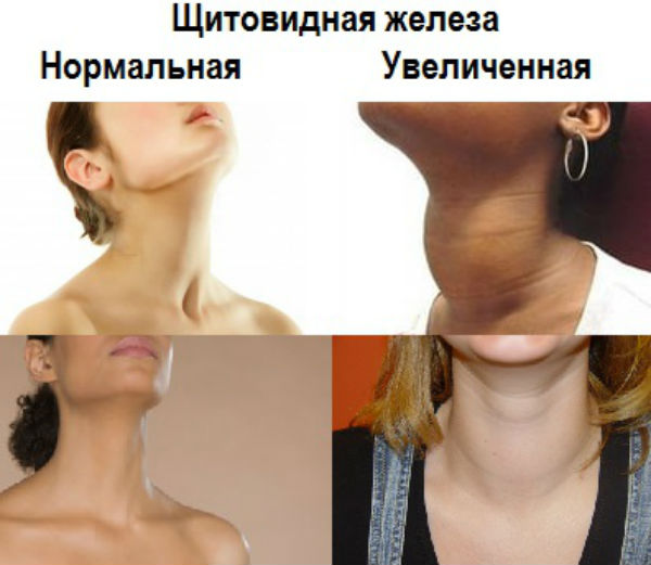 Как вызуально проверить щитовидку фото