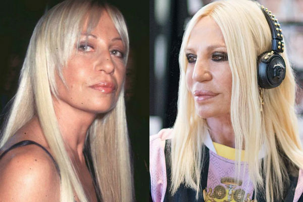 Донателла Версачи до и после пластических операций фото