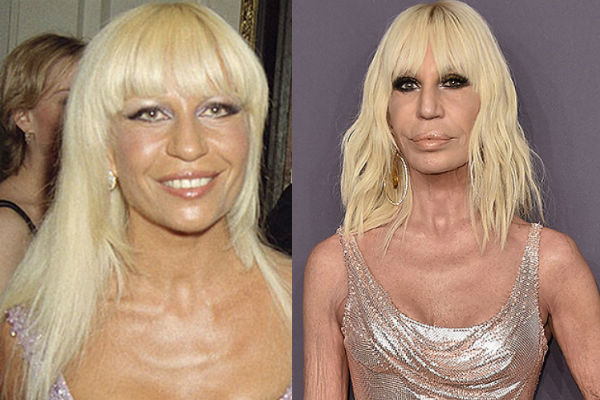 Донателла Версачи до и после пластических операций на лице и теле фото