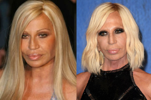 Донателла Версачи до и после пластики лица фото