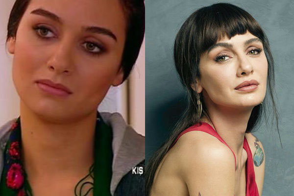 Турецкая актриса и модель Бирдже Акалай до и после пластики лица фото