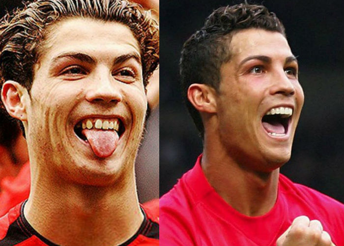 Известный португальский футболист Криштиану Роналду до и после корректирующей пластики лица фото