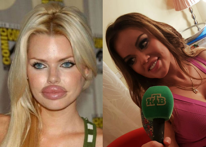 Олеся Малибу до и после пластики лица, увеличения груди и губ фото