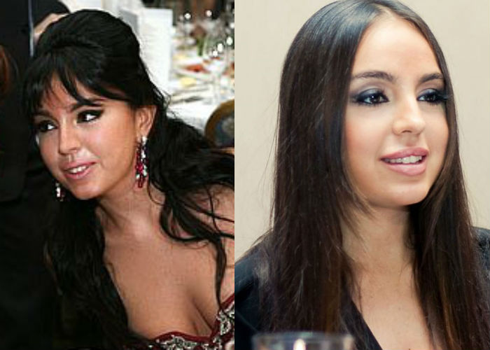Лейла Алиева до и после пластики лица фото