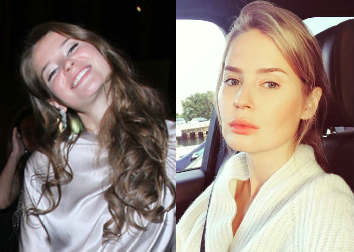 Алена Гаврилова до и после пластики носа и губ фото