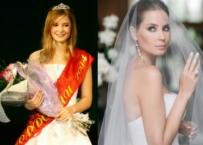 Модель Алена Гаврилова до и после пластики носа и губ фото