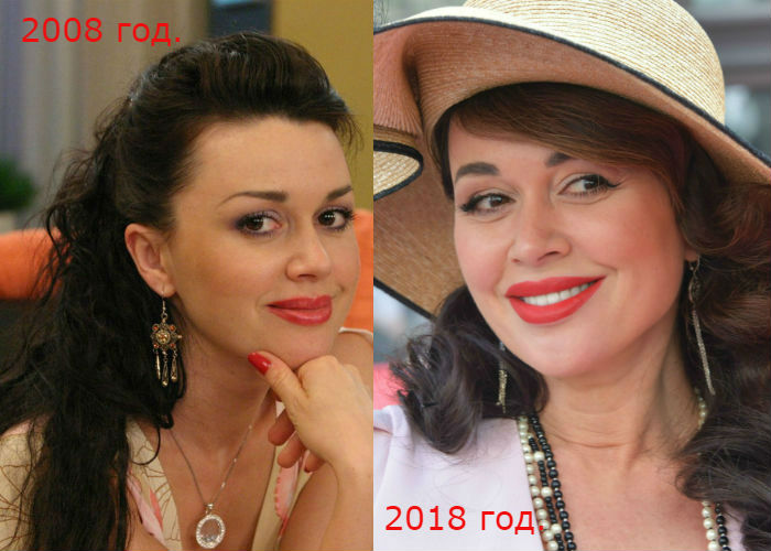 Актриса Анастасия Заворотнюк после пластики лица фото